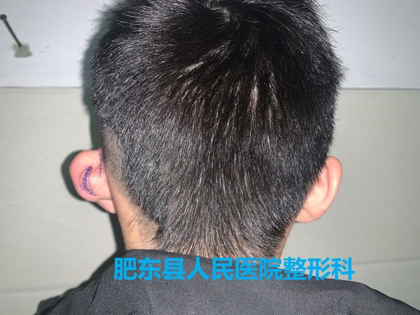 术前背面.jpg