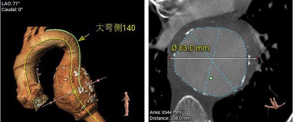 图1：术前CTA示巨大胸主动脉瘤.png