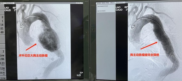 图三：术中覆膜支架植入前后DSA造影对比.png